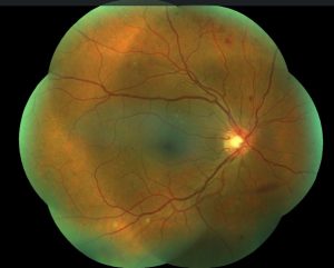 retinopatía diabética proliferativa