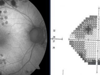 Autofluorescencia vs Amputación del campo visual del ojo derecho producida por el tratamiento láser 532 nm
